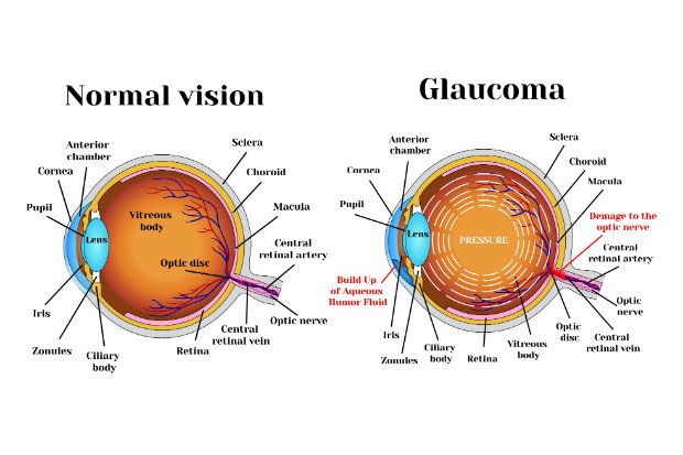 What is Glaucoma and should you be worried?
