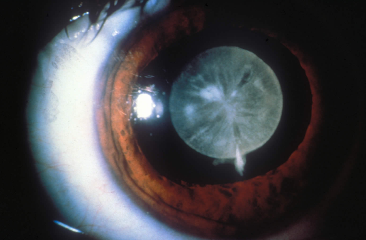 The Truth about Cataracts